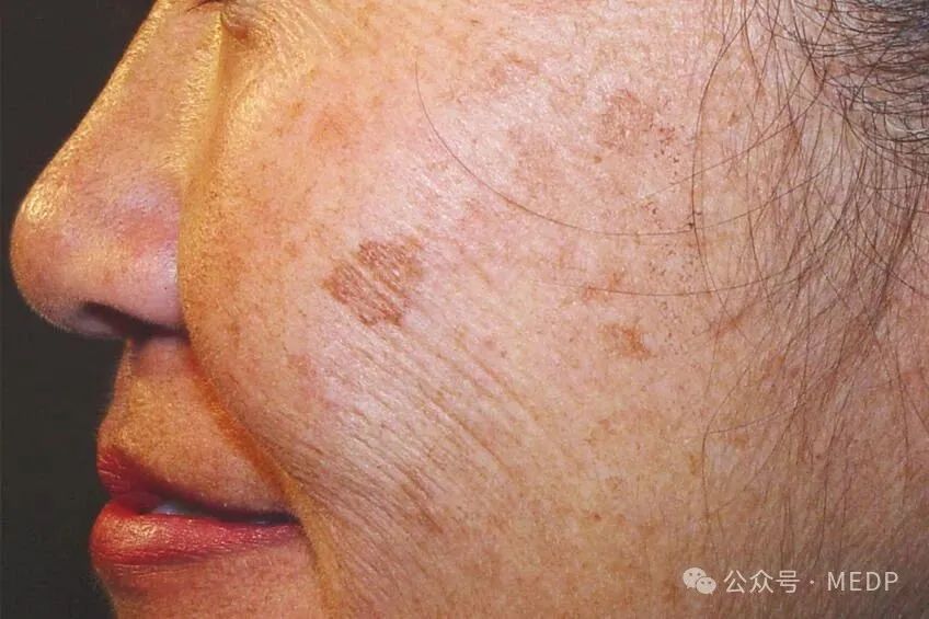老年斑、晒斑、日光性雀斑是一回事吗？